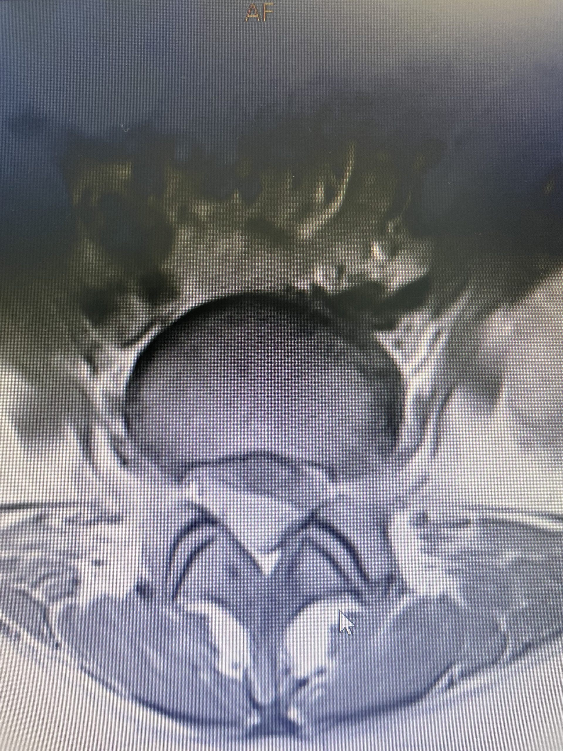 Transitional Lumbar Segment | NSPC Brain & Spine Surgery