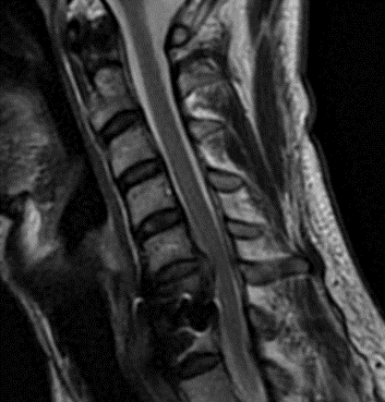 Preoperative MRI demonstrating C5-6 disc herniation with stenosis, adjacent to the previous C6-7 ACDF