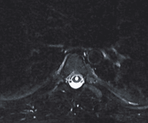 MRI of thoracic spine showing syringomyelia