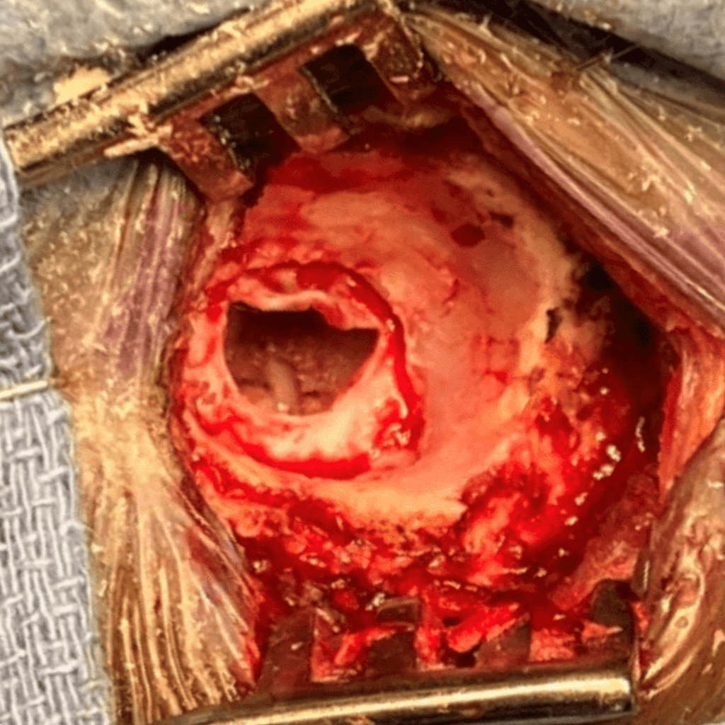 Surgical View of a Microvascular Decompression (MVD) for Trigeminal Neuralgia 6