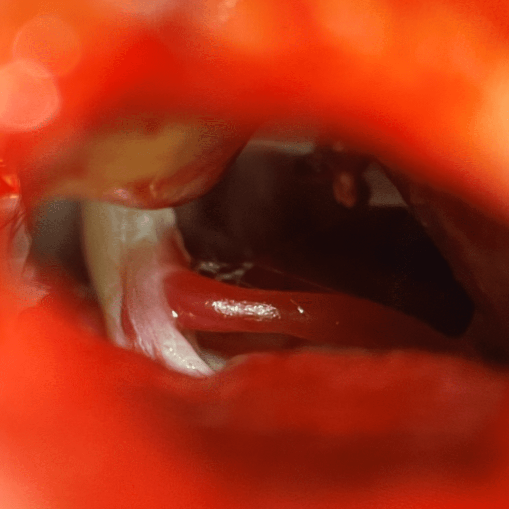 Surgical View of a Microvascular Decompression (MVD) for Trigeminal Neuralgia 1
