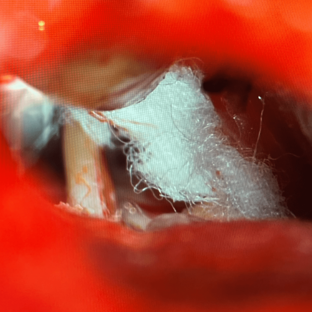 Surgical View of a Microvascular Decompression (MVD) for Trigeminal Neuralgia 2