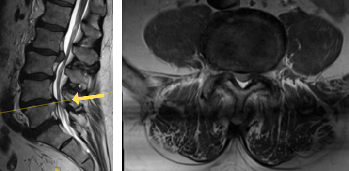 1A shows central stenosis at L4/L5 level associated with grade 1 spondylolisthesis