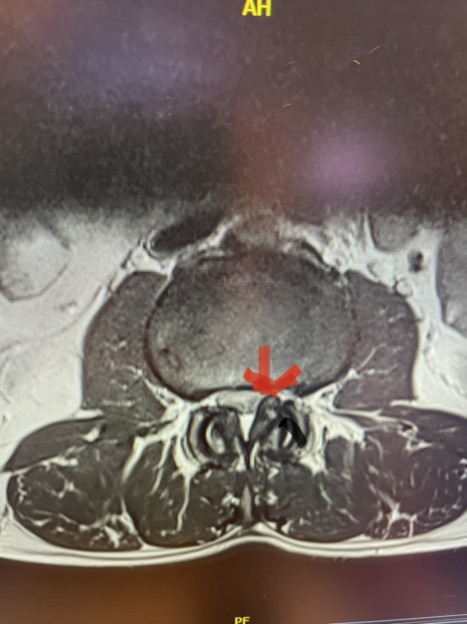 Lateral Recess Stenosis NSPC Brain Spine Surgery