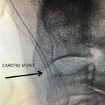 Unusual Indication for Carotid Stenting Over Endarterectomy 4
