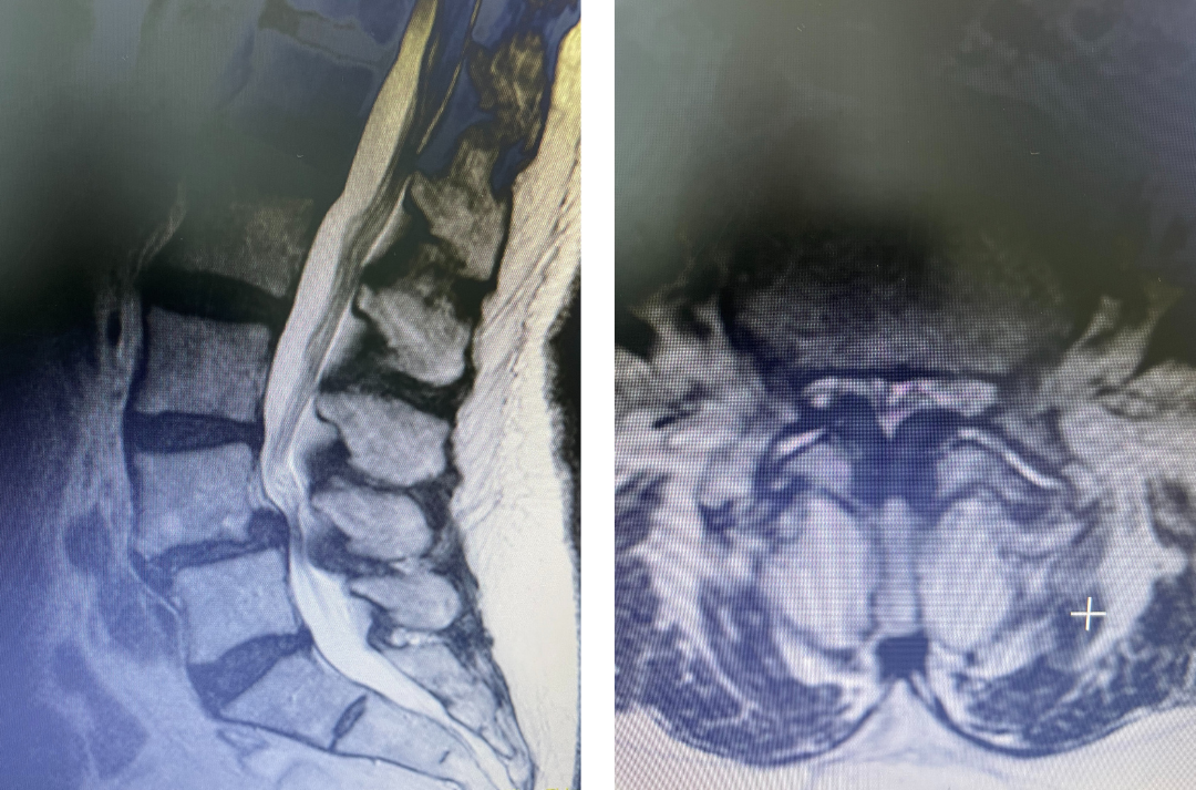 figure 1a and 1b lumbar stenosis