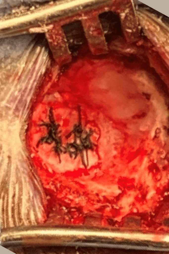Surgical View of a Microvascular Decompression (MVD) for Trigeminal Neuralgia 3