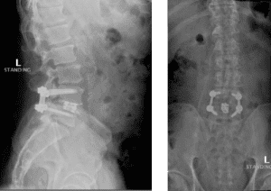 Post-op x-rays that show L4/L5 transforaminal lumbar interbody fusion (TLIF). There was also removal the L2/L3 disc herniation but no need for instrumentation