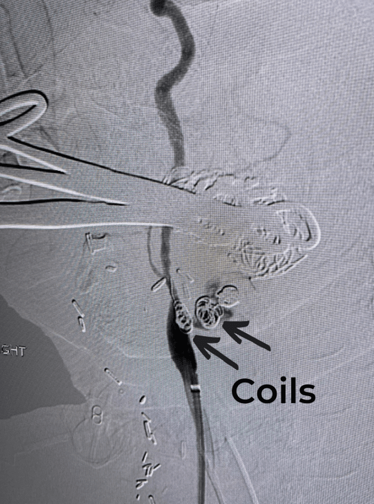 In-process treatment image illustrates packing of eroded carotid artery with coils