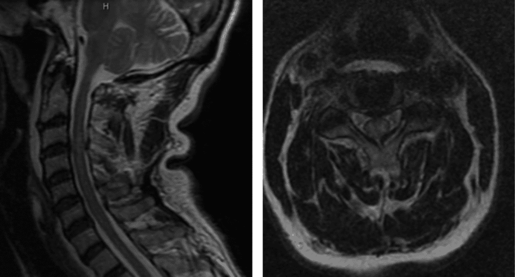 T2 MRI sagittal and axial showing C3/C4 disc herniation with compression of the spinal cord; spinal cord edema at the C3/C4 level