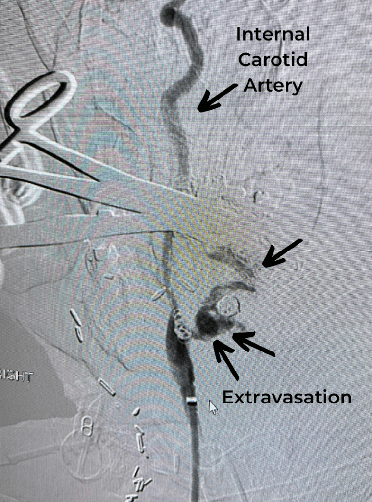 Angiographic image shows external carotid artery blowout