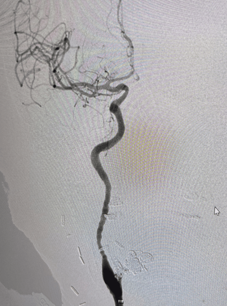 Post-treatment image shows good filling of the internal carotid artery with intracranial circulation and no further extravasation of contrast, suggesting complete cessation of the bleeding