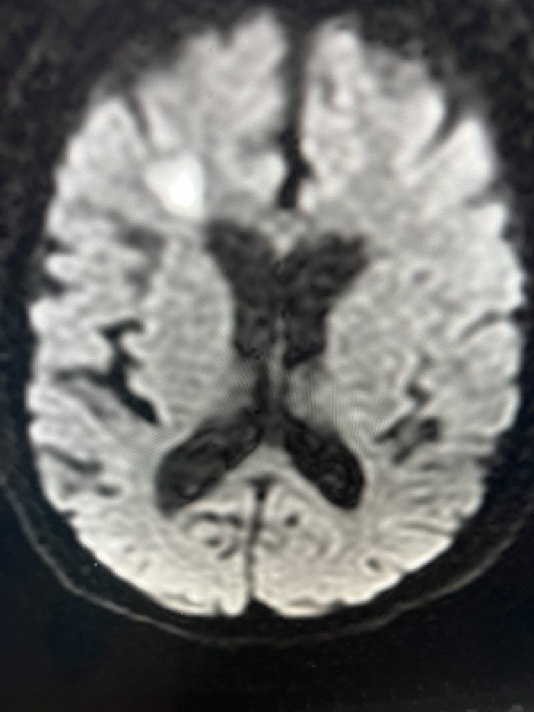 Pre-operative imaging using a diffusion-weighted image sequence, shows multiple areas of most likely embolic stroke in the right frontal white matter