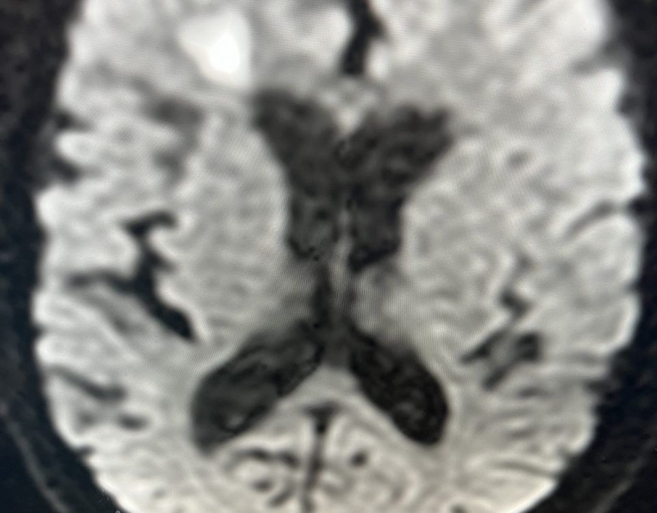 JLB Symptomatic Carotid Stenosis Fig. 1 Image scaled