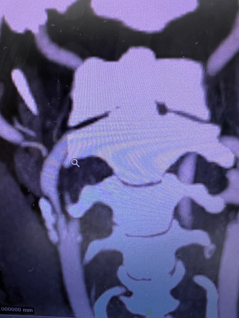Pre-operative CTA image confirms high-grade carotid stenosis from a calcified atherosclerotic plaque
