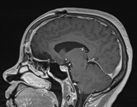 Postoperative MRI demonstrating a complete resection without residual enhancement