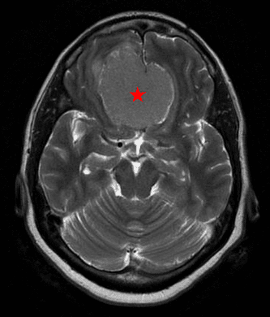 Preoperative MRI demonstrating an extra-axial lesion with surrounding vasogenic edema and mass effect on the frontal lobes