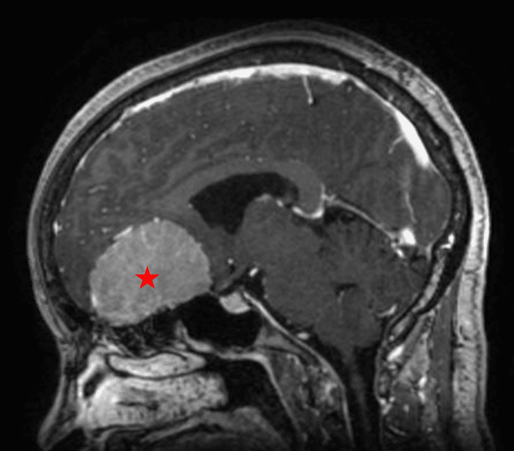 Preoperative MRI demonstrating an extra-axial enhancing mass of the anterior cranial fossa