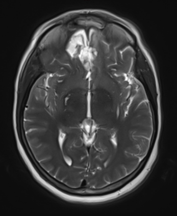 Postoperative MRI demonstrating resolution of mass effect