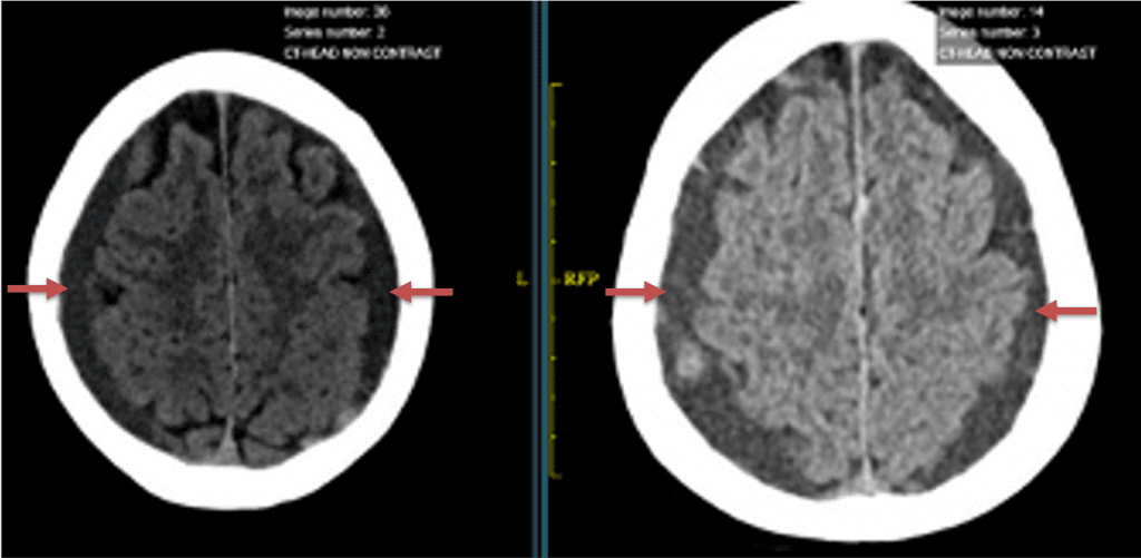 A) 6 weeks post mild trauma B) 4 weeks post mild trauma demonstrates stable subacute subdural collections with mild growth and sulcal effacement