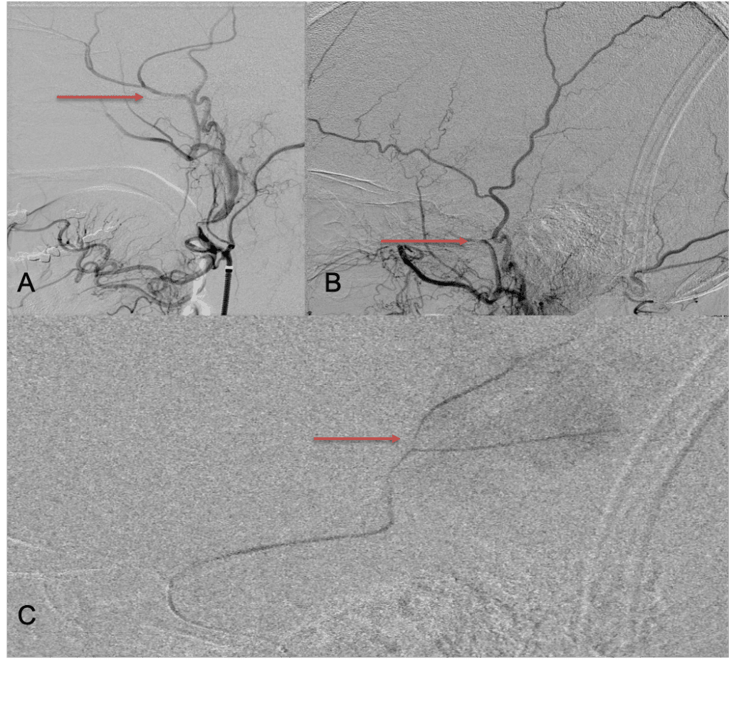 A) Initial right ECA angiogram ; B) Post MMA Embolization; C) Selective Embolization Of Middle Meningeal Artery Membranes using PVA particles (arrows)