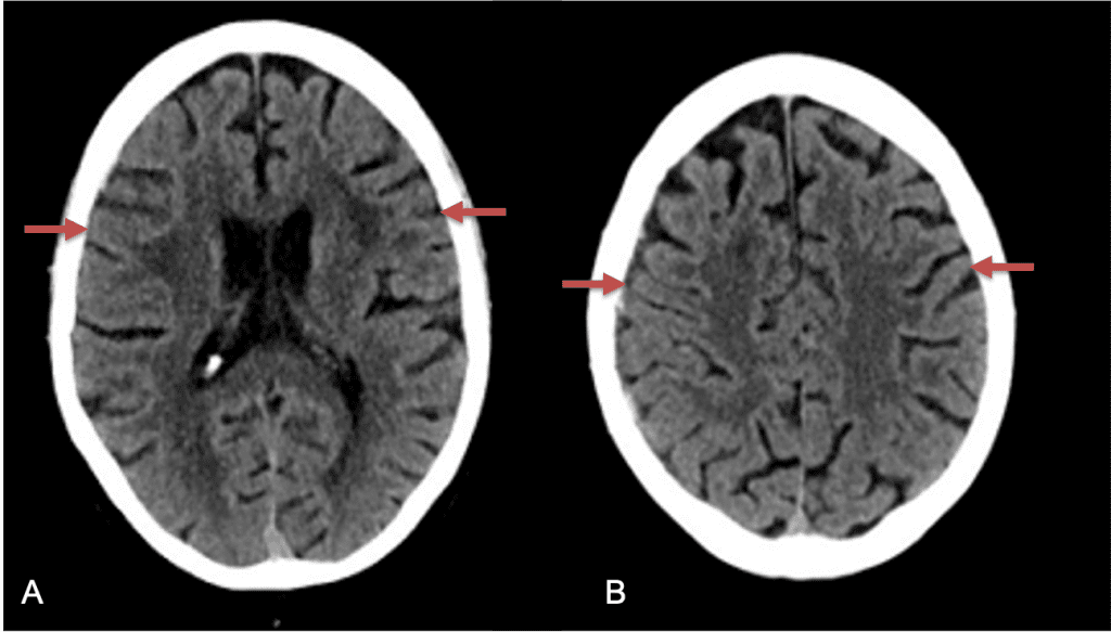A and B) – 10 weeks following embolization demonstrates complete resolution of bilateral collections both acute and chronic