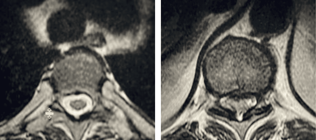fig 2 thoracic