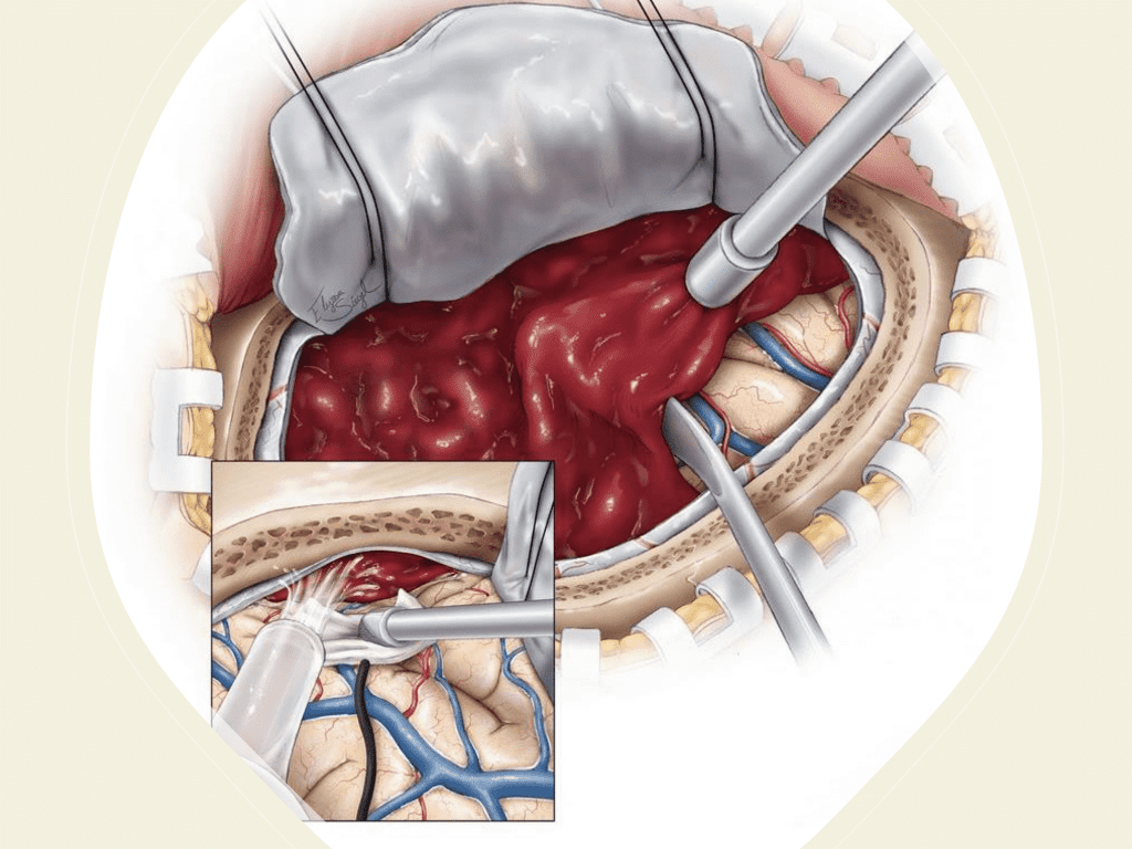 Surgical craniotomy for Subdural Hematoma