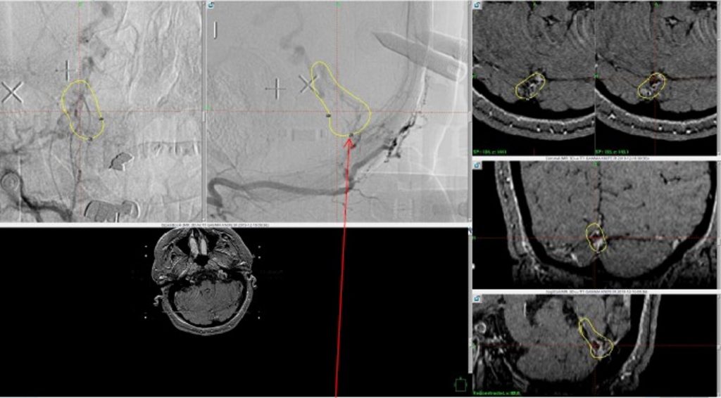 MRI and Catheter Angiograms precisely localize the residual A-V shunts vessels to perform Gamma-Knife Radiosurgery to deliver therapeutic doses to the targets