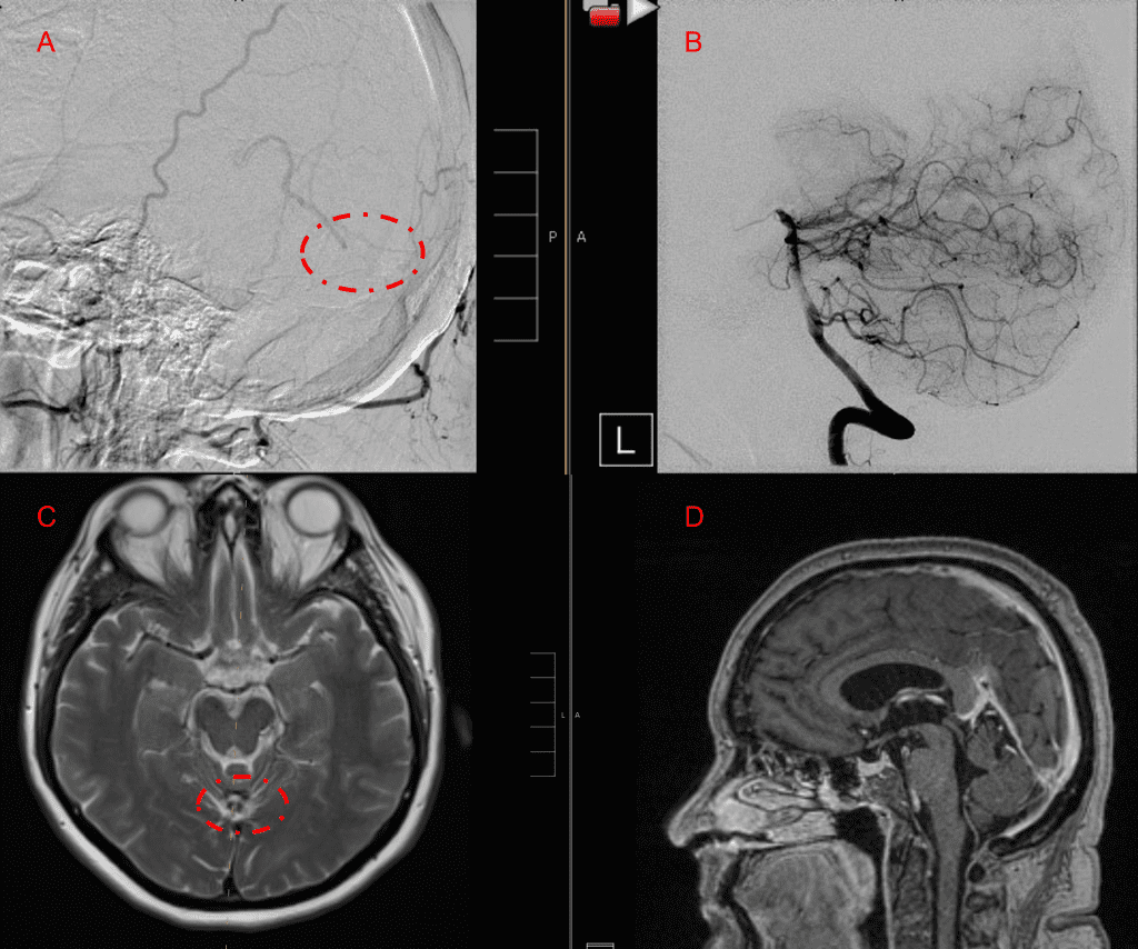 12 mos follow-up angiograms confirm complete obliteration of the left ECA and Vertebral Supply to the AVM, with a small late-filling component from the right Occipital artery that is markedly Reduced in size and flow (top row). Near complete resolution of the aneurysm and hematoma Is observed on 16 mos post Gamma Knife MRI (bottom row)
