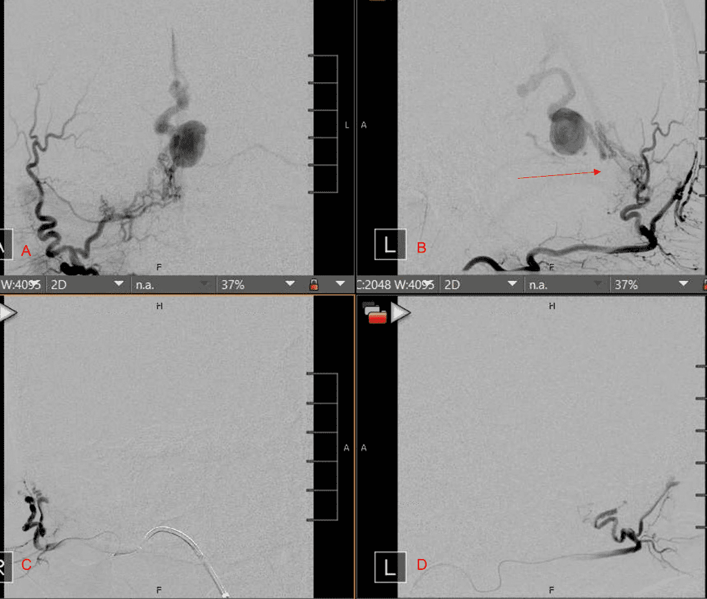 Right ECA AP and Lateral angiograms Pre (A and B) and Post NBCA embolization (C and D) Demonstrate near complete obliteration of right Occipital and Middle Meningeal Artery Fistulas