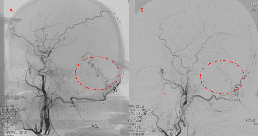 Bilateral ECA Lateral angiograms (A and B) demonstrates small residual indirect supply To the AVM from the bilateral Occipital arteries