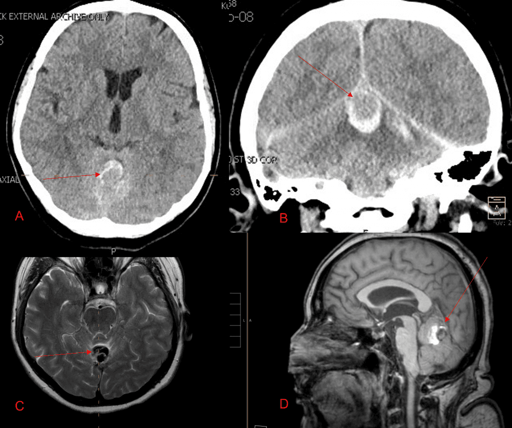 A and B) Non-Contrast CT Axial and Coronal demonstrate large, ruptured Varix/Aneurysm along the Incisura of the posterior fossa which appears to have mixed hemorrhagic components and enhancement on MRI T2 and post contrast imaging (C and D)