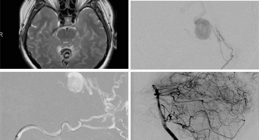 Left ECA AP and Lateral angiograms Pre (A and B) and Post NBCA embolization (C and D) Demonstrate near complete obliteration of Left Occipital Artery Fistulas