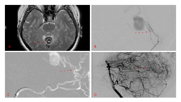 [A] Ruptured Varix/Aneurysm of the Deep Venous Posterior Fossa drainage and AV shunting (arrows) [B] Posterior Meningeal Artery Fistula [C] Right Middle Meningeal Artery Fistula [D] Post embolization Left Vertebral Angiogram demonstrates resolution of the high flow and pressure A-V Shunting following successful embolization with liquid embolic (NBCA)