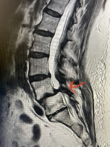 Fig 1: Sagittal T2-weighted lumbar MRI demonstrating grade 1-2 spondylolisthesis L4-5 with severe stenosis (red arrow)