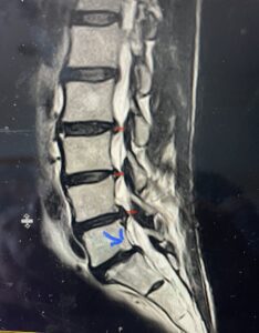T2-weighted lumbar MRI demonstrating severe lumbar stenosis (red markers) and a grade 1 spondylolisthesis at L5-S1 (blue arrow)