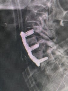 lateral intraoperative cervical x-ray demonstrating good alignment after C4-C6 anterior cervical discectomy and interbody fusion with plate. Note the interbody grafts help load-share the plate in this patient with severe osteoporosis