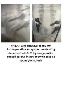 lateral and AP intraoperative X-rays demonstrating placement at L5-S1 hydroxyapatite-coated screws in patient with grade 1 spondylolisthesis