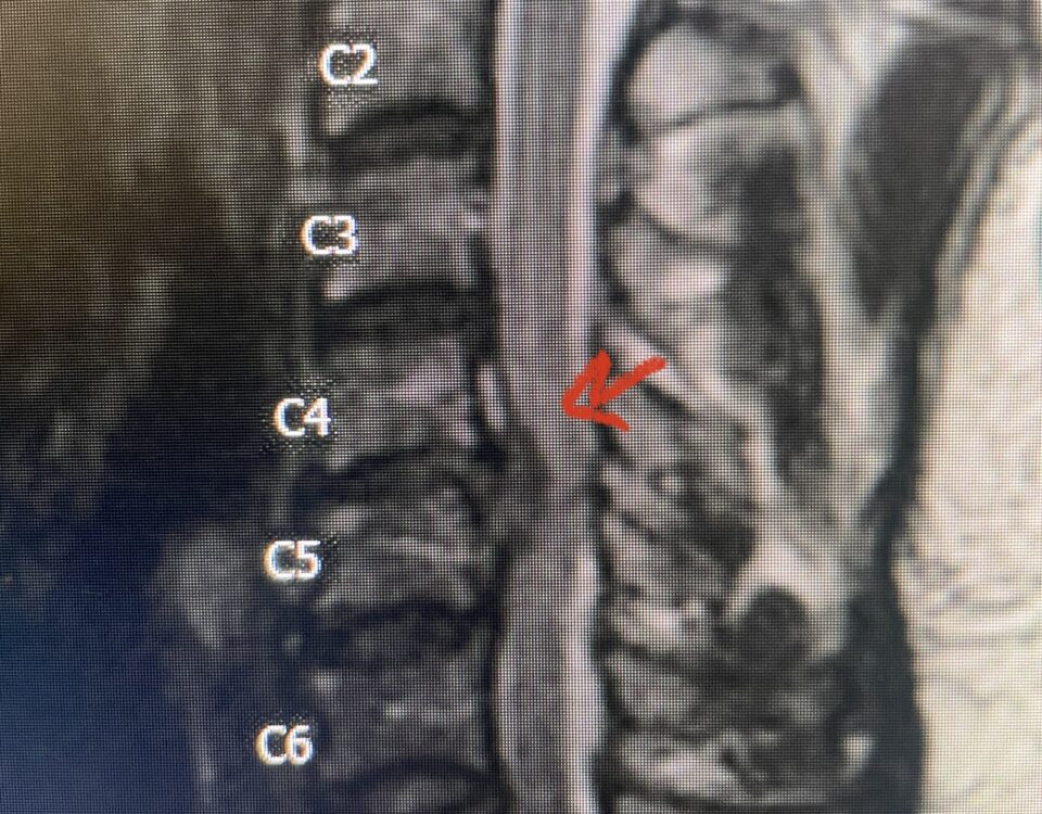 Fig 2a Sagittal and axial T2 weighted cervical MRIs demonstrating large C4 5 herniated disc with spinal cord compression red arrows