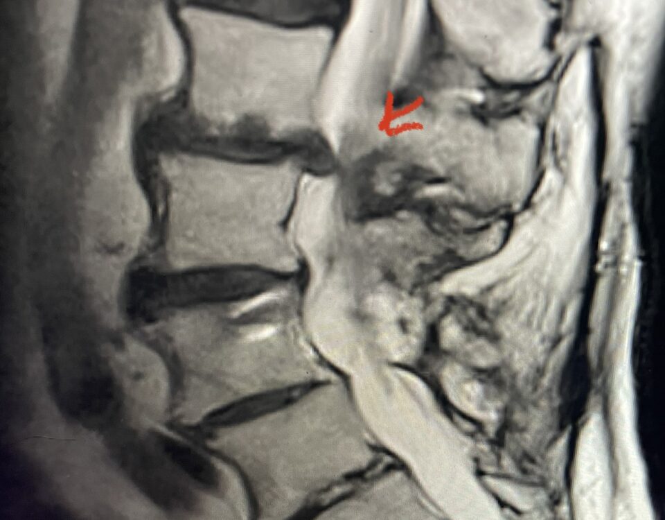 Fig 1 Sagittal and axial T2 weighted lumbar and 1B L4-S1 instrumented fusion