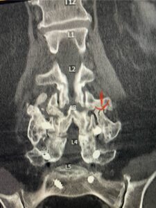 Fig.2: Coronal lumbar CT demonstrating L4-S1 fusion with instrumentation with some incomplete bony fusion to the L3-4 segment (red arrow)