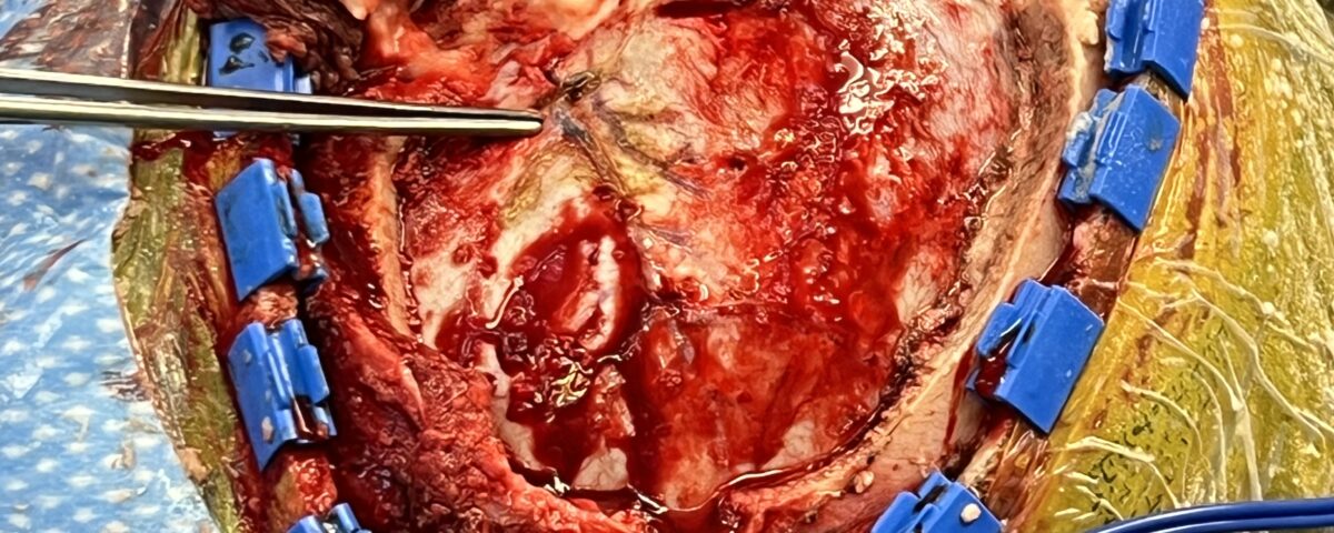 Fall Brain Tumor Update - Brain Neurosurgeons Collaborate Case Study - At treatment image - Embolized Vessels Fig_ 3 Image