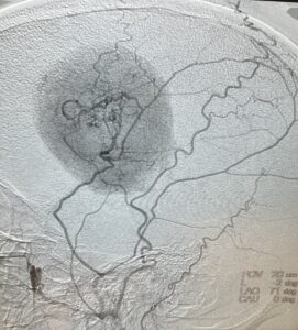 Fall Brain Tumor Update - Brain Neurosurgeons Collaborate Case Study - Pre-Embolization Fig_ 1 crop Image