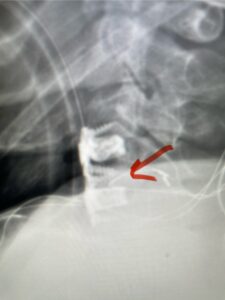 IMG_4615 Fig 9: Lateral intraoperative cervical x-ray demonstrating good position of interbody cages at C 3-4 and C 4 5 with anterior cervical plate (red arrow)